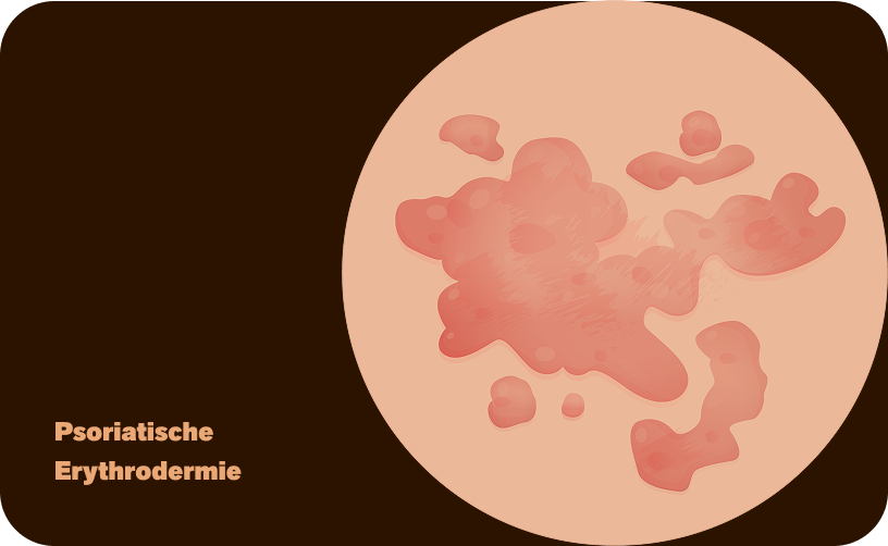 Erythrodermie-DE-ohne Text